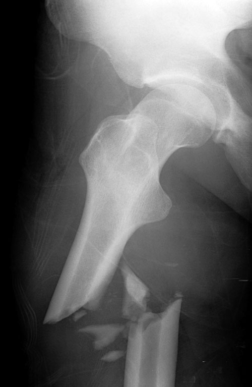 Трещина тазобедренного. Диафизарный перелом бедра рентген. Перелом диафиза бедренной кости рентген. Перелом бедренной кости рентген. Перелом диафиза бедренной кости.